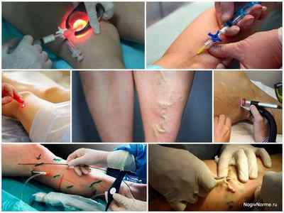 Сучасні методи лікування варикозу нижніх кінцівок - консервативна терапія і малоінвазивні процедури