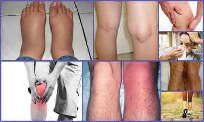 Супрапателлярний бурсит колінного суглоба - симптоми і лікування