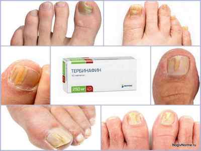 Таблетки Тербінафін від грибка нігтів: інструкція із застосування, ціна, відгуки, аналоги, побічні ефекти