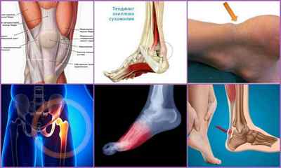 Тендиніт: види, причини, симптоми, лікування
