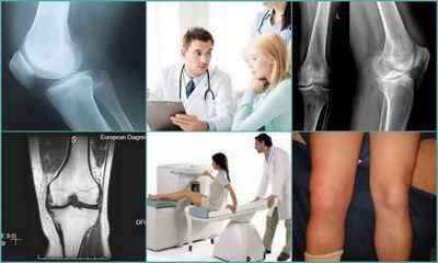 Тендіноз колінного суглоба - симптоми і лікування
