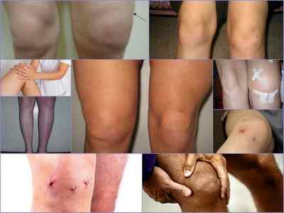 Ускладнення після артроскопії меніска колінного суглоба: болить і розпухло коліно, контрактура, випіт, синовіт