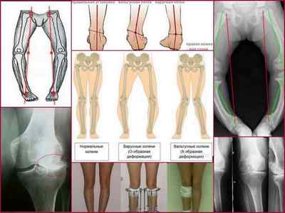 Вальгусна деформація колінних суглобів у дітей і дорослих: фото, лікування, відгуки