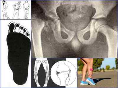 Вальгусна деформація колінних суглобів у дітей і дорослих: фото, лікування, відгуки