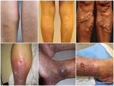 Варикозна хвороба нижніх кінцівок: причини, симптоми, класифікація і лікування