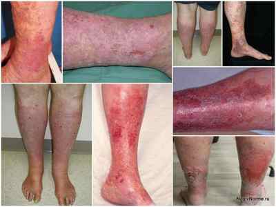Варикозний дерматит нижніх кінцівок: фото, причини, симптоми, лікування