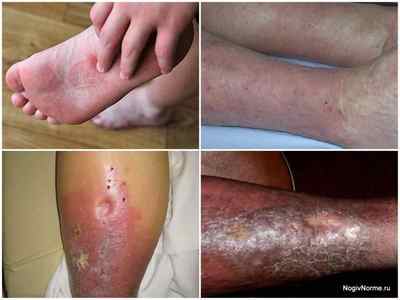 Варикозний дерматит нижніх кінцівок: фото, причини, симптоми, лікування