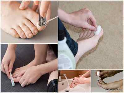 Вартнер Нейл Експерт від грибка нігтів: інструкція із застосування, ціна, відгуки