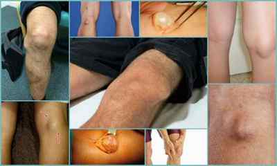 Видалення кісти Бейкера колінного суглоба: розміри для операції, види, підготовка, хід операції, реабілітація