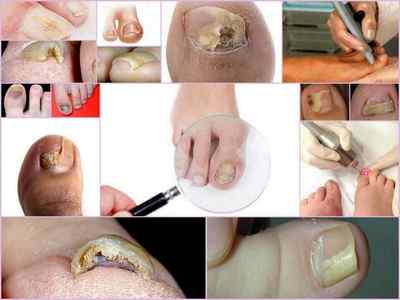 Видалення нігтя на нозі при грибку: професійні методи і засоби для зняття в домашніх умовах