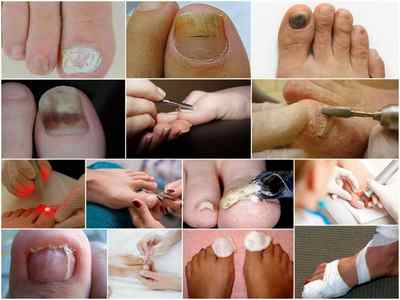 Видалення нігтя на нозі при грибку: професійні методи і засоби для зняття в домашніх умовах
