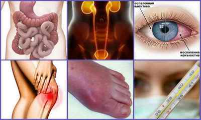 Види артритів: які бувають, класифікація різновидів, діагностика