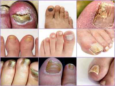 Види грибка нігтів на ногах - фото і опис