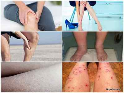 Внутрішній варикоз вен на ногах: симптоми, фото, лікування