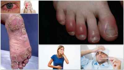 Вірусний артрит: симптоми і лікування у дітей та дорослих