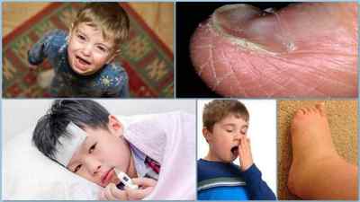 Вірусний артрит: симптоми і лікування у дітей та дорослих