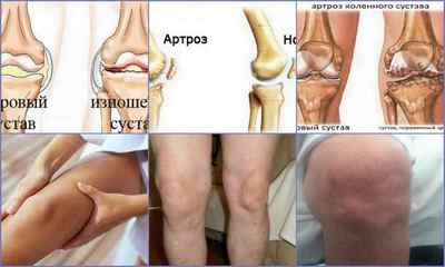 Які бувають хвороби колінного суглоба - симптоми, діагностика, методи лікування
