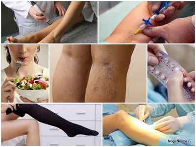 Як лікувати варикоз на ногах у жінок: причини, симптоми, фото, методи лікування