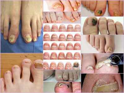 Як виглядає грибок нігтів на ногах - фото і опис симптомів