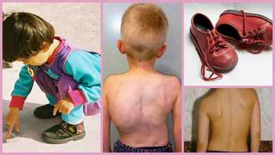 Як визначити плоскостопість у дитини - симптоматика, методи діагностики