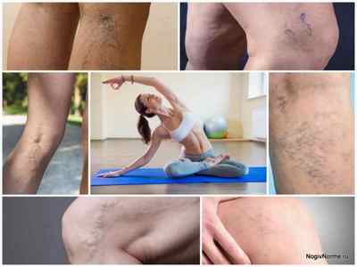 Йога при варикозі нижніх кінцівок: комплекс вправ, АССА, мудрі