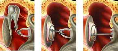Тимпанопластика, операція на середнє вухо: типи, показання, проведення