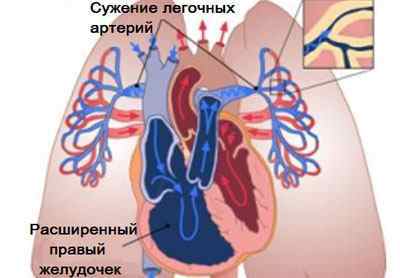 Типи задишки при бронхіальній астмі