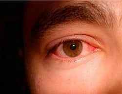 Токсоплазмоз очей: симптоми і лікування очного поразки паразитами