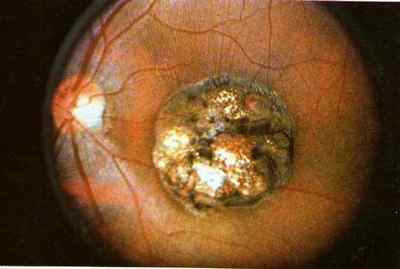 Токсоплазмоз очей: симптоми і лікування очного поразки паразитами
