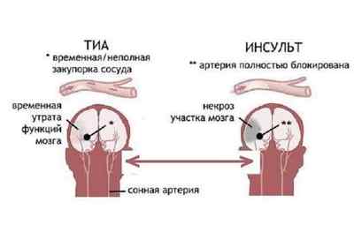 Транзиторна ішемічна атака головного мозку