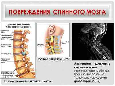 Травма спинного мозку, забій і пошкодження відділу хребта