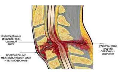 Травма спинного мозку, забій і пошкодження відділу хребта