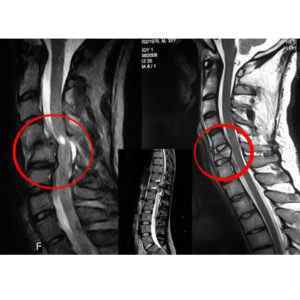 Травми спинного мозку: ознаки перелому хребта з пошкодженням спинного мозку, симптоми і лікування, як перевірити | Ревматолог