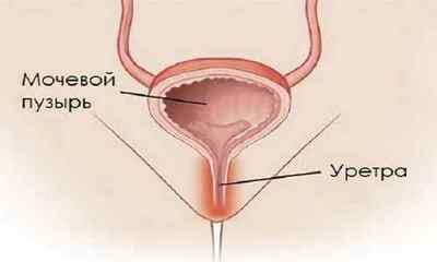 Тріхомонадний вагініт: причини, лікування, симптоми