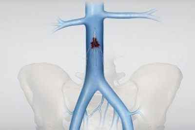 Тромбоемболія легеневої артерії: симптоми, невідкладна допомога, лікування
