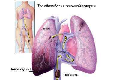 Тромбоемболія легеневої артерії: симптоми, невідкладна допомога, лікування