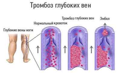 Тромбоз глибоких вен нижніх кінцівок: симптоми, лікування, профілактика