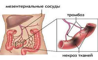 Тромбоз кишечника: причини виникнення та методи лікування