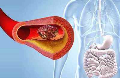 Тромбоз мезентеріальних судин кишечника: причини і методи лікування