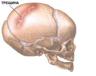 Тріщина в черепі - симптоми, лікування і наслідки