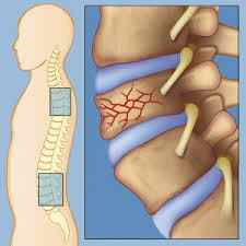Тріщина в хребті: симптоми і лікування вертикальної тріщини в хребці, наслідки в поперековому відділі, чим небезпечна | Ревматолог