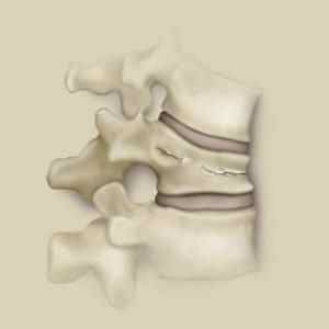 Тріщина в хребті: симптоми і лікування вертикальної тріщини в хребці, наслідки в поперековому відділі, чим небезпечна | Ревматолог