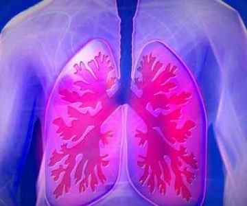 Туберкульоз бронхів: симптоми, лікування