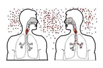 Туберкульоз внутрішньогрудних лімфовузлів: симптоми, лікування