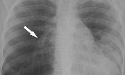 Туберкульоз внутрішньогрудних лімфовузлів: симптоми, лікування