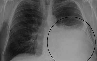 Туберкульозний плеврит: симптоми, лікування, наслідки