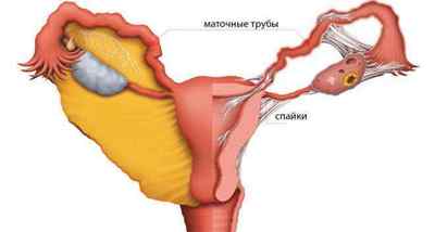 У чому різниця ендометриту і ендометріозу