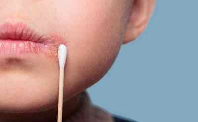 У дитини в роті герпес - докладно про симптоми і лікування
