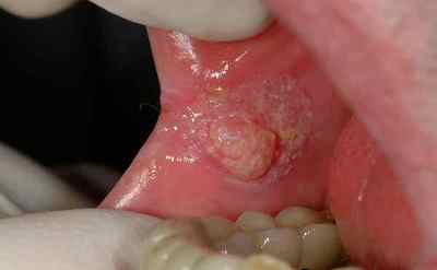 У дитини в роті герпес - докладно про симптоми і лікування