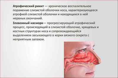 У носі постійно утворюються корки: причини і лікування